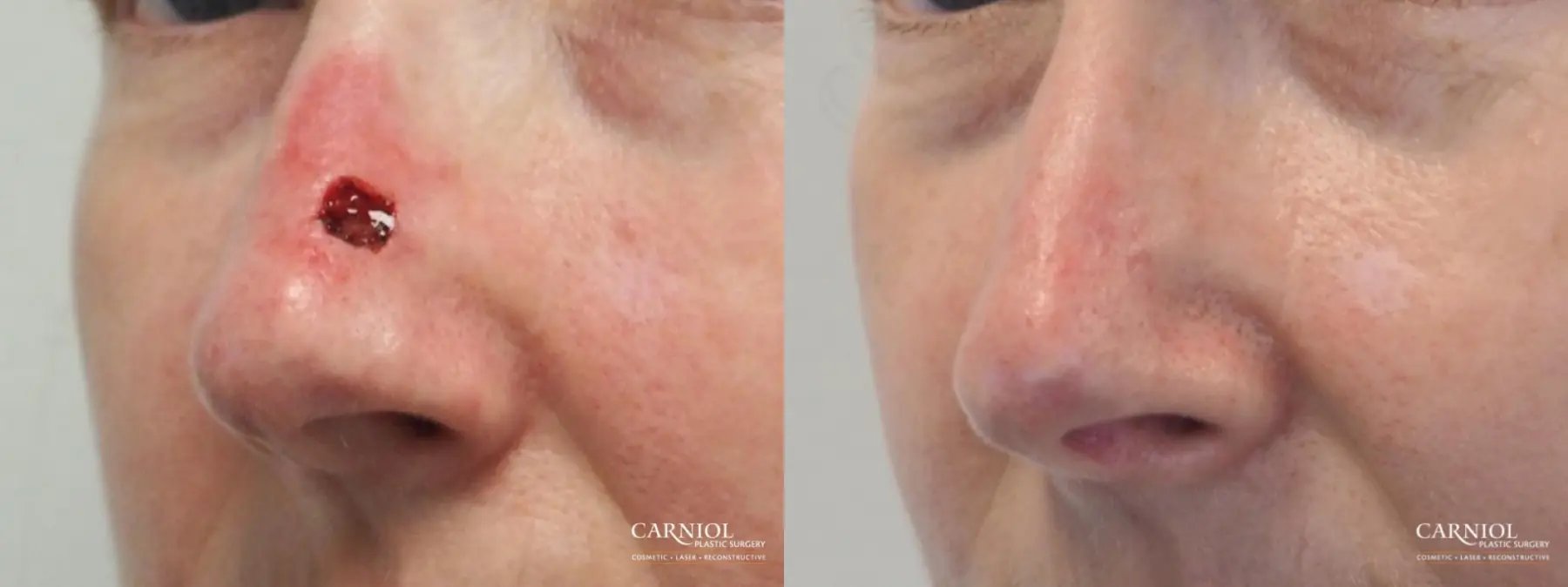 Skin Cancer Reconstruction - Face: Patient 9 - Before and After 1