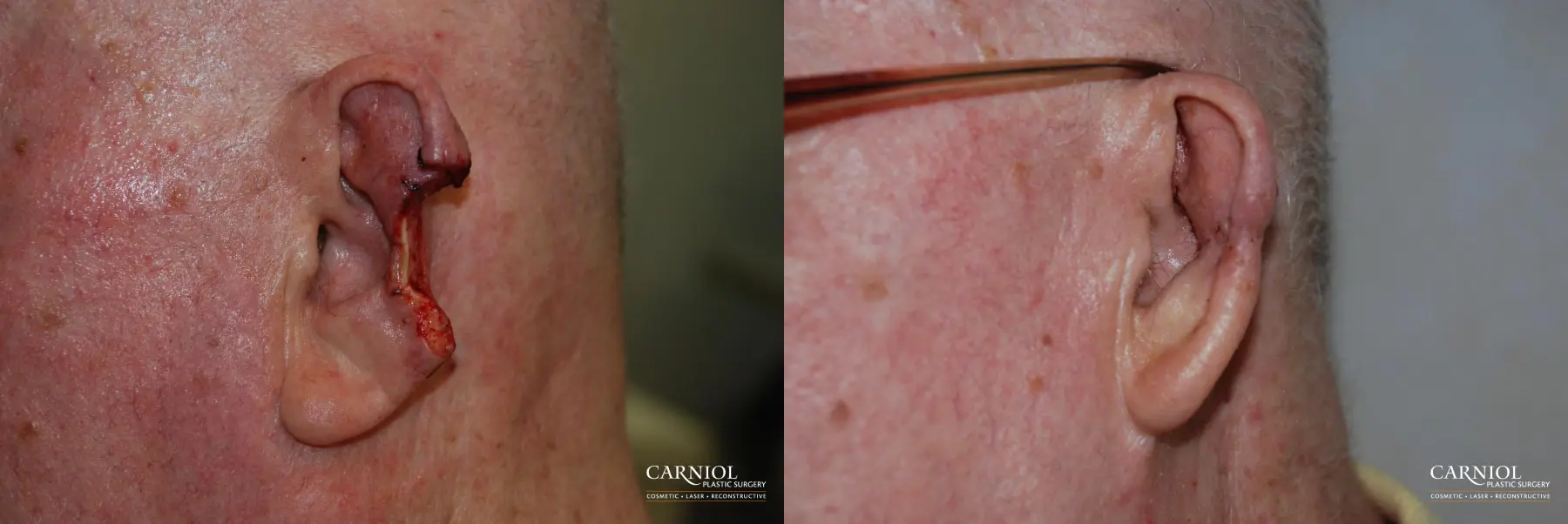 Skin Cancer Reconstruction - Face: Patient 1 - Before and After 1