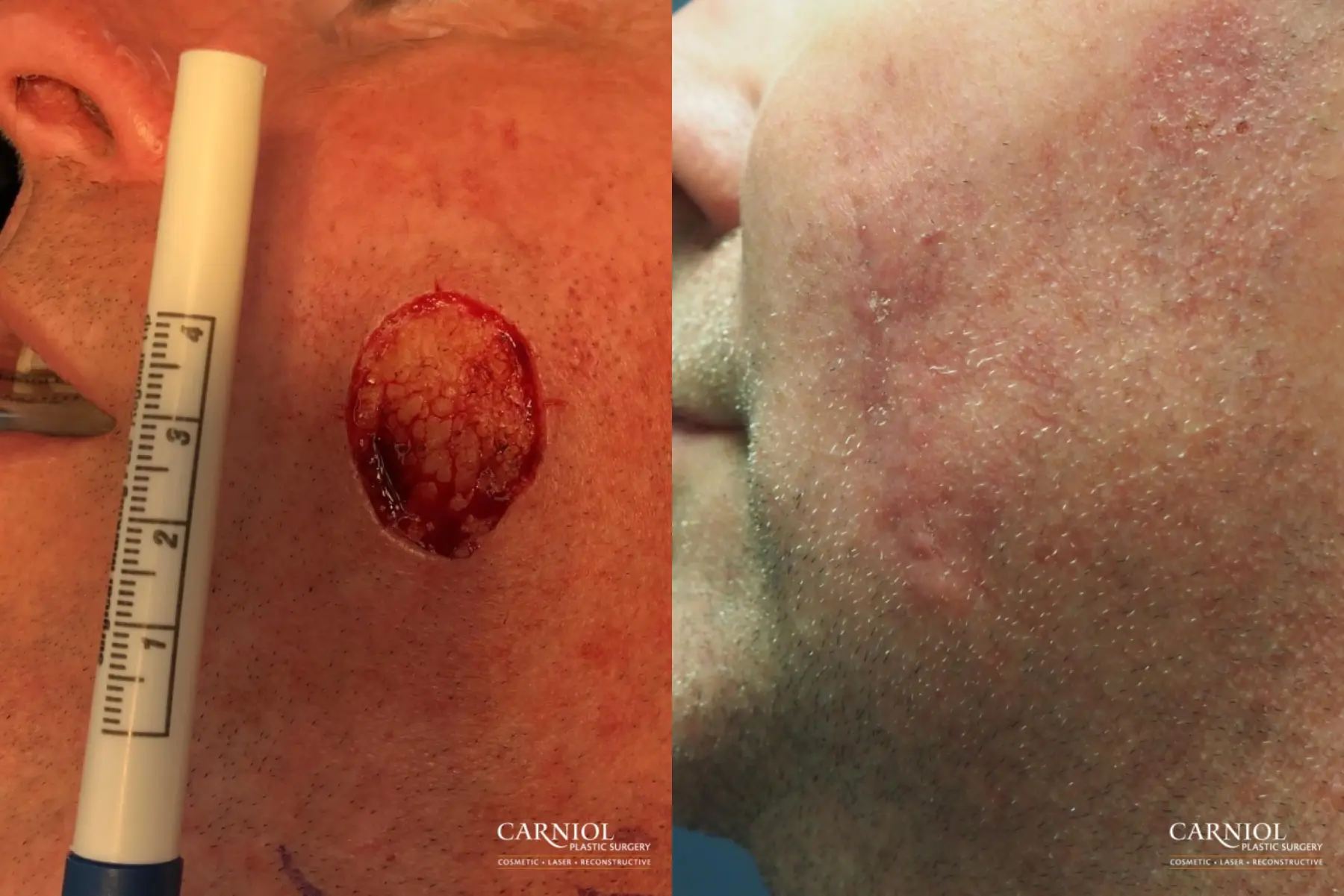 Skin Cancer Reconstruction - Face: Patient 11 - Before and After  