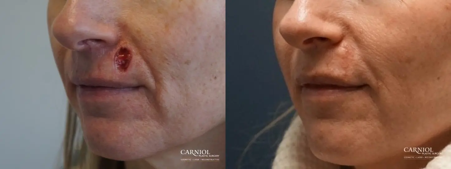 Skin Cancer Reconstruction - Face: Patient 12 - Before and After 1