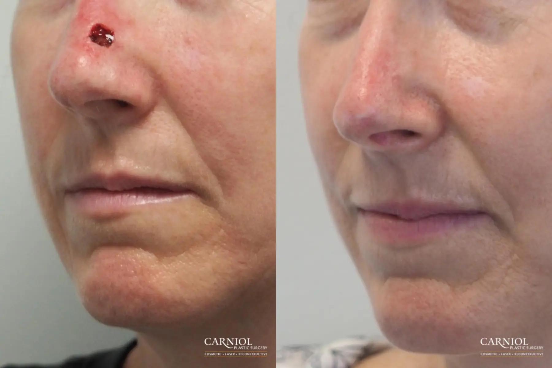 Skin Cancer Reconstruction - Face: Patient 10 - Before and After 1