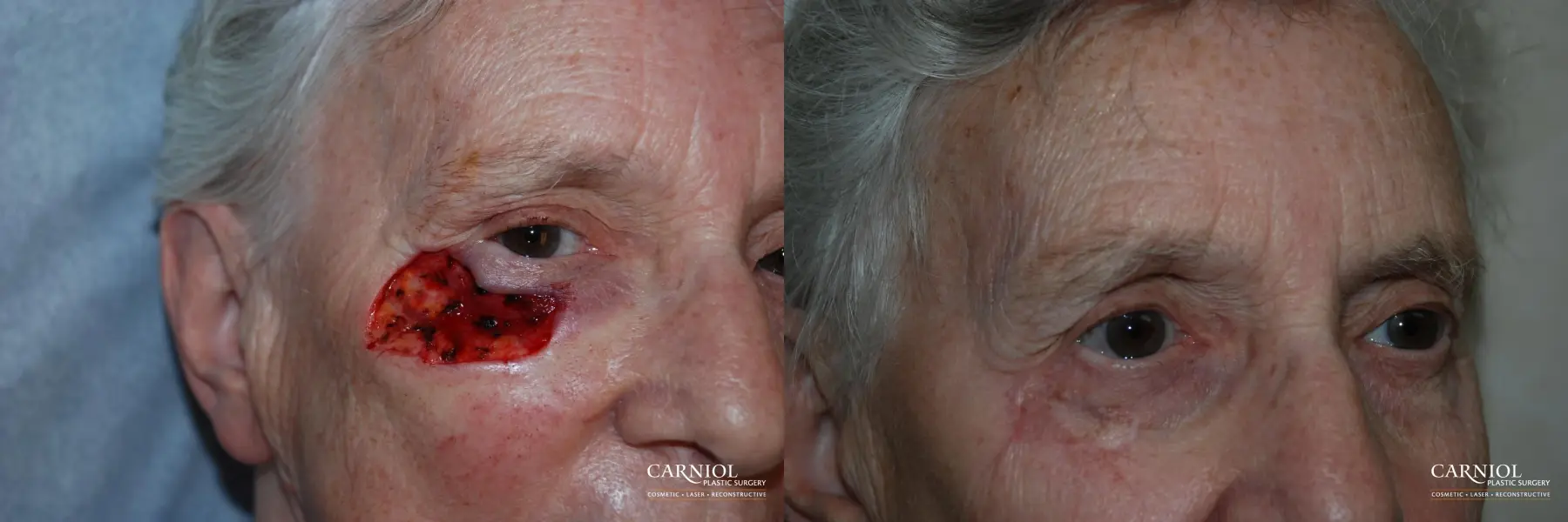 Skin Cancer Reconstruction - Face: Patient 5 - Before and After 1