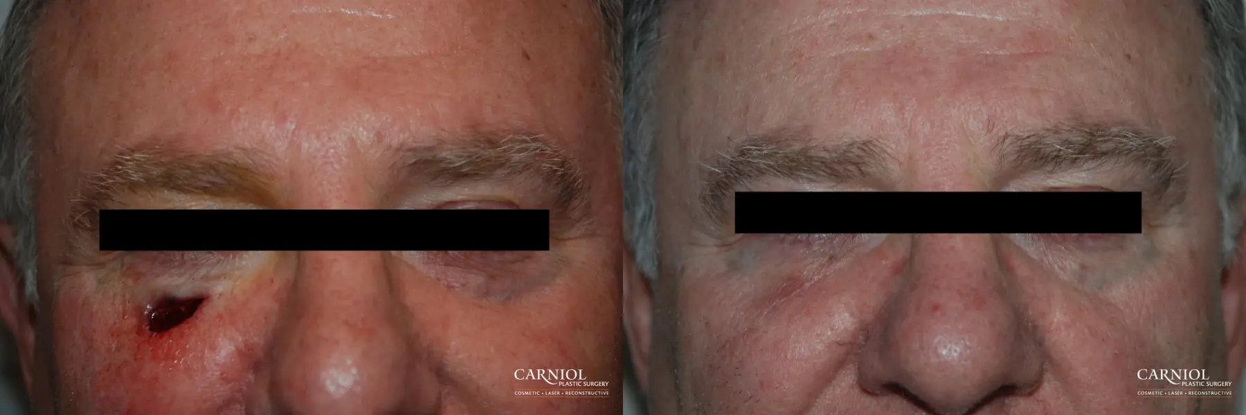Skin Cancer Reconstruction - Face: Patient 4 - Before and After 1