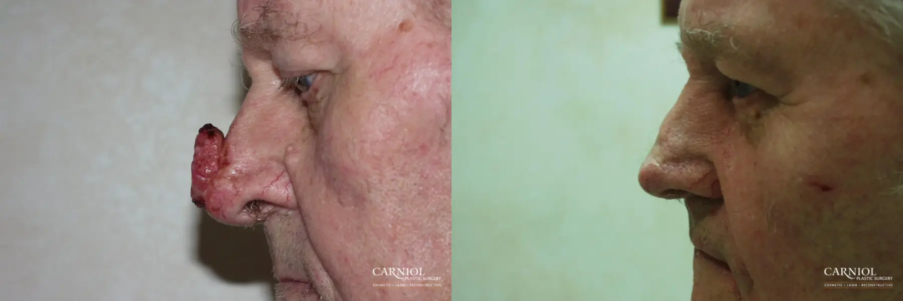 Skin Cancer Reconstruction - Face: Patient 8 - Before and After 1