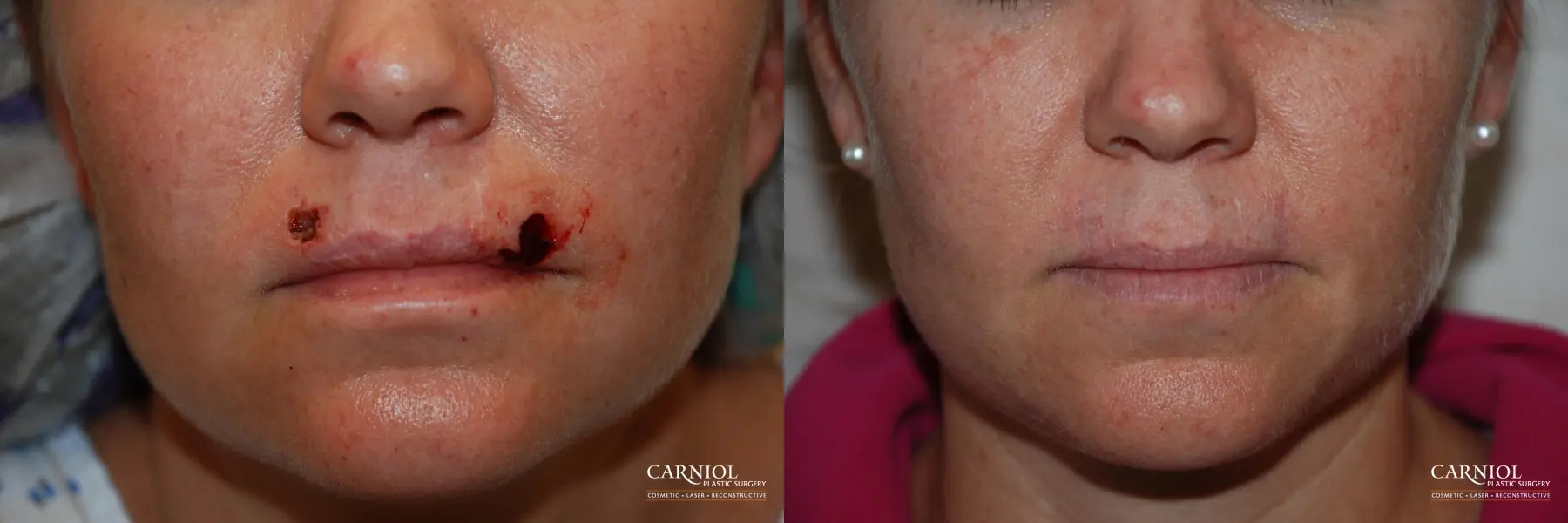 Skin Cancer Reconstruction - Face: Patient 6 - Before and After 1