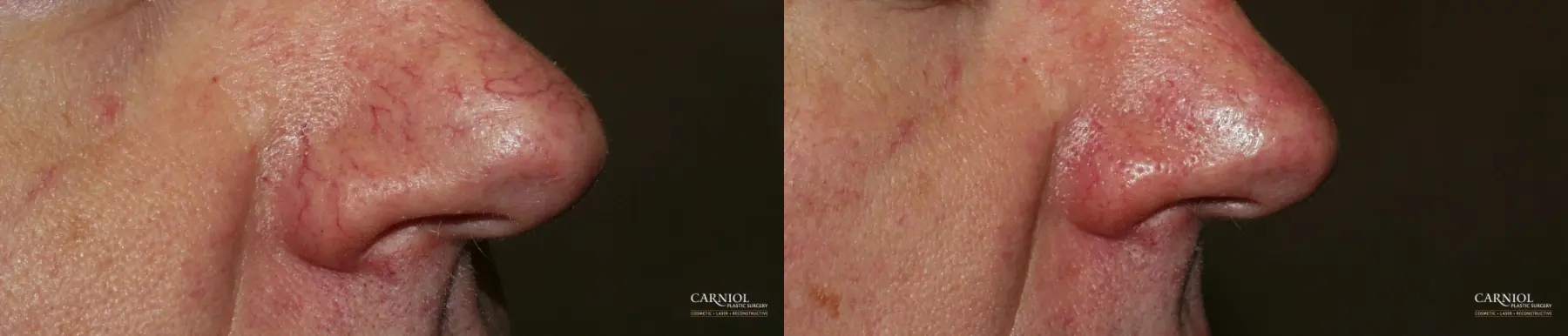 Spider Veins: Patient 1 - Before and After 1