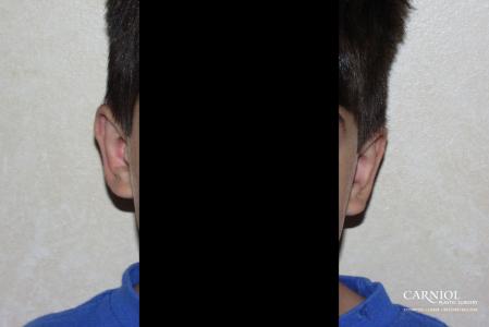 Otoplasty: Patient 2 - After Image 1