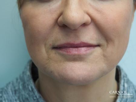 Fillers: Patient 5 - Before Image 1