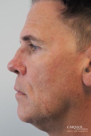 Non-Surgical Facelift: Patient 2 - After Image 3