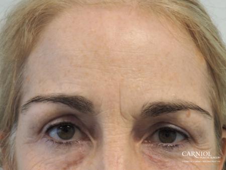 BOTOX® Cosmetic: Patient 5 - Before Image