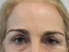 BOTOX® Cosmetic: Patient 5 - Before Image