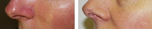 Spider Veins: Patient 2 - Before and After  