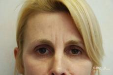 BOTOX® Cosmetic: Patient 1 - Before Image