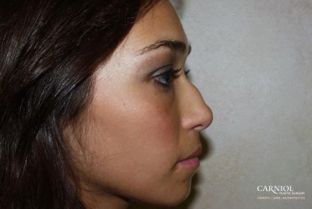Rhinoplasty: Patient 2 - Before Image 1