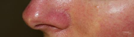 Rosacea: Patient 1 - Before Image 1