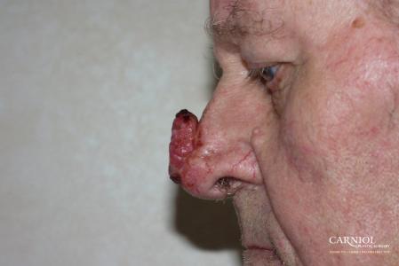 Skin Cancer Reconstruction - Face: Patient 8 - Before Image 1