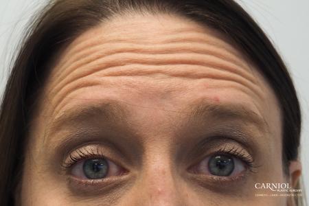 BOTOX® Cosmetic: Patient 4 - Before Image 2