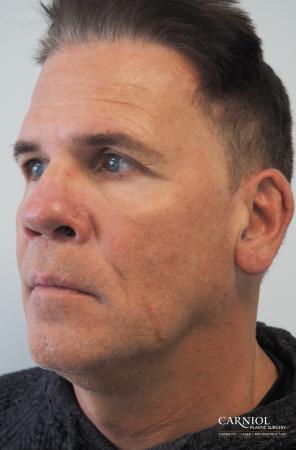Non-Surgical Facelift: Patient 2 - After Image 1