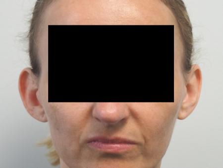 Otoplasty: Patient 3 - Before Image 1