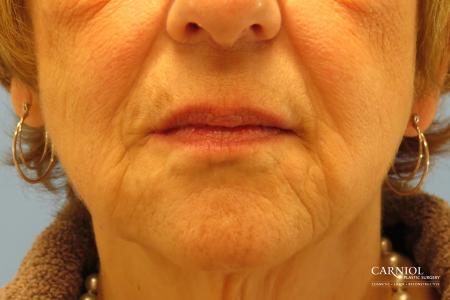 Non-Surgical Mini-Facelift: Patient 9 - After Image 1