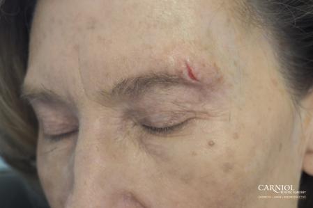 Scar Revision: Patient 4 - Before Image 1