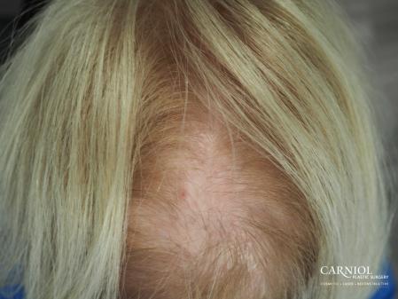 Nonsurgical Hair Restoration: Patient 3 - Before Image 1