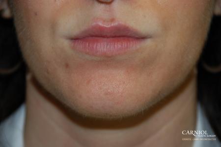Lip Augmentation: Patient 2 - After Image 1