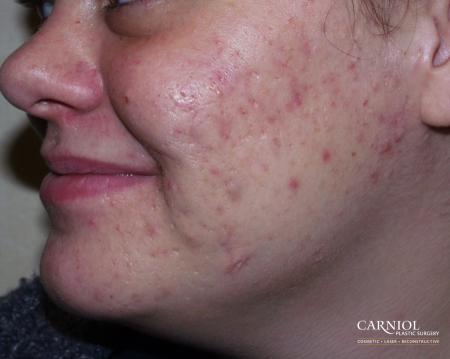 Acne Rejuvenation: Patient 1 - After Image 1