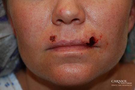 Skin Cancer Reconstruction - Face: Patient 6 - Before Image 1