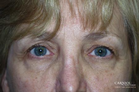 Eyelid Lift: Patient 4 - Before Image 1
