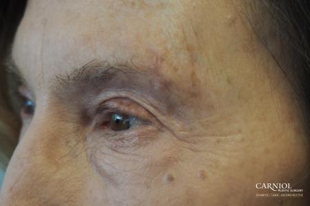 Scar Revision: Patient 4 - After Image 1