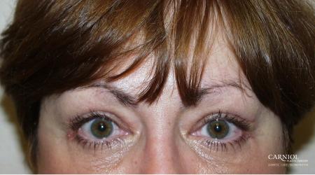 Eyelid Lift: Upper and Lower Blepharoplasty - After Image 1