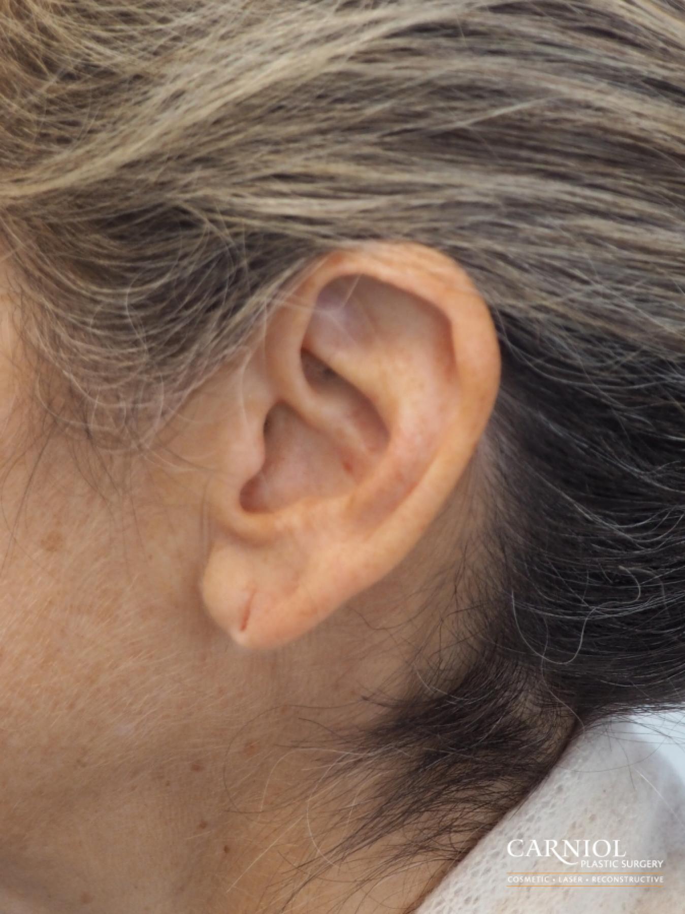 Earlobe Surgery: Patient 2 - Before and After  