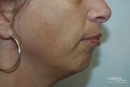 Non-Surgical Mini-Facelift: Patient 3 - Before Image 1