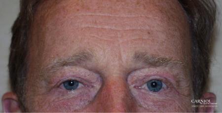 Eyelid Lift: Patient 3 - After Image 1