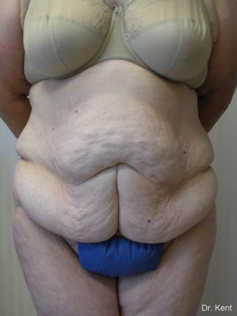 Post Bariatric Reconstruction: Patient 1 - Before 1