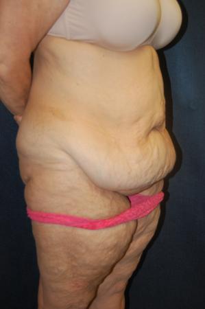 Post Bariatric Reconstruction: Patient 9 - Before 2