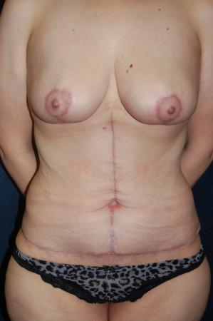 Post Bariatric Reconstruction: Patient 10 - After 1