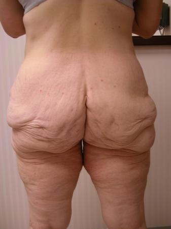 Post Bariatric Reconstruction: Patient 4 - Before and After 3