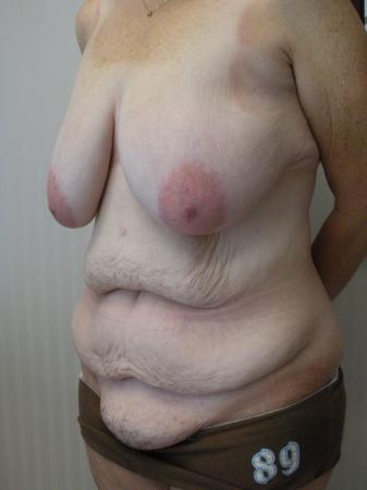 Post Bariatric Reconstruction: Patient 6 - Before and After 2