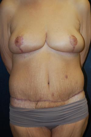 Post Bariatric Reconstruction: Patient 8 - After  