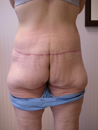 Post Bariatric Reconstruction: Patient 4 - After 3