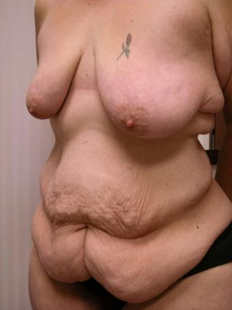 Post Bariatric Reconstruction: Patient 2 - Before and After 2