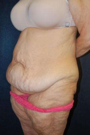 Post Bariatric Reconstruction: Patient 9 - Before and After 3