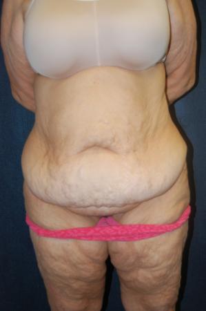 Post Bariatric Reconstruction: Patient 9 - Before 