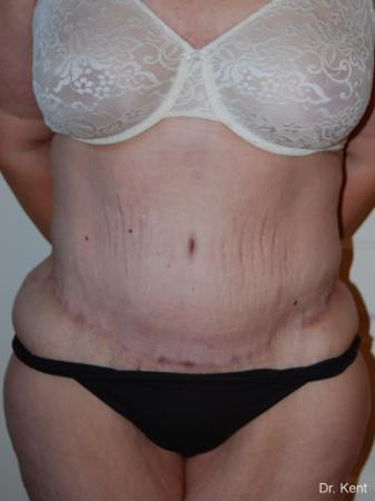 Post Bariatric Reconstruction: Patient 1 - After  