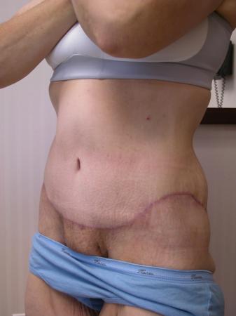 Post Bariatric Reconstruction: Patient 4 - After 2