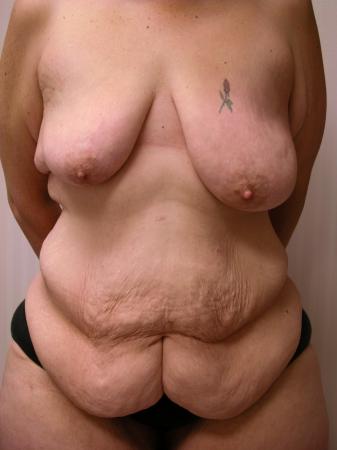 Post Bariatric Reconstruction: Patient 2 - Before 