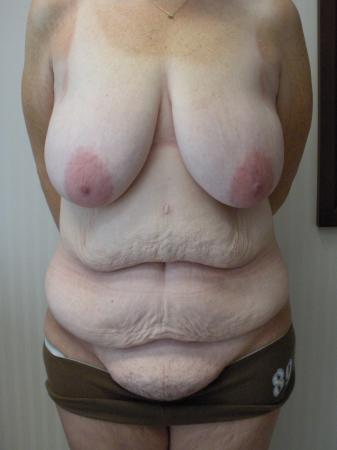 Post Bariatric Reconstruction: Patient 6 - Before 1