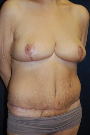 Post Bariatric Reconstruction: Patient 8 - After 2
